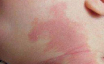 南京维多利亚医院：鲜红斑痣的危害有哪些